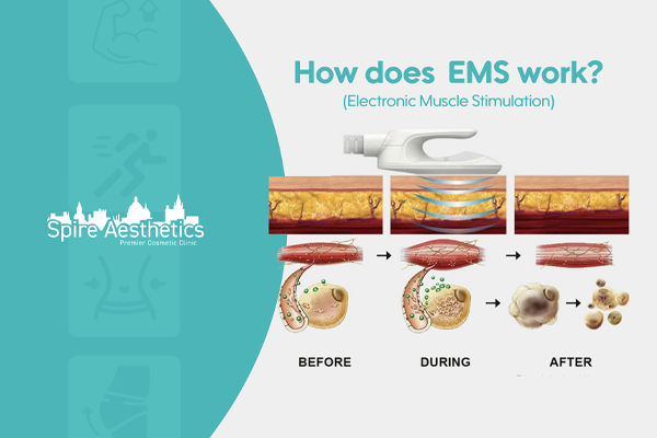 EMS treatment for post pregnancy weight loss treatment Kingswinford