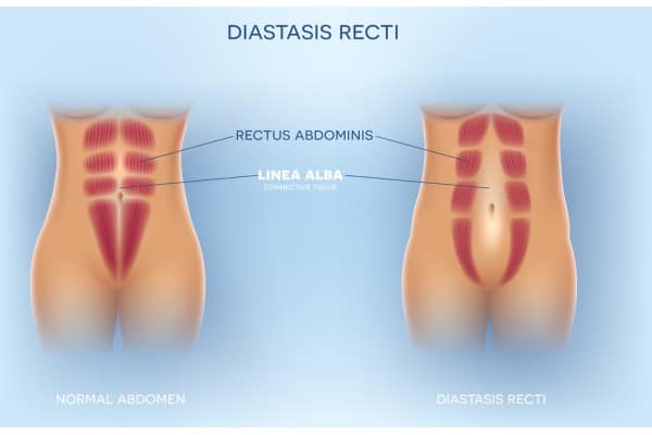 What Non-Surgical Options Are Available for Diastasis Recti Kingswinford?