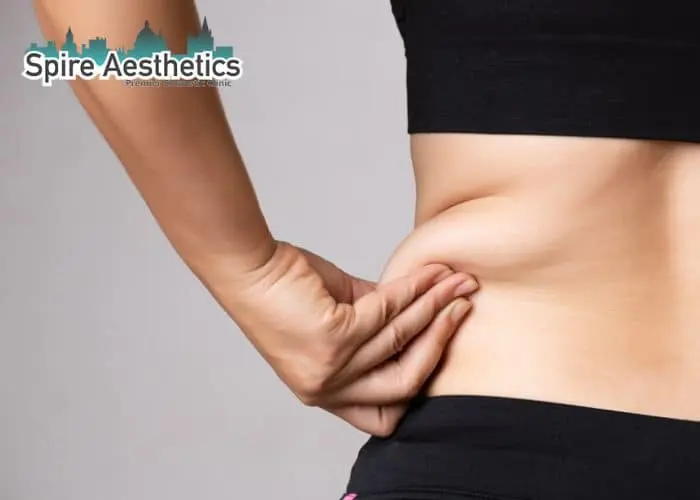Image of woman pinching fat on their hips Kingswinford. Fat Freezing treatment 