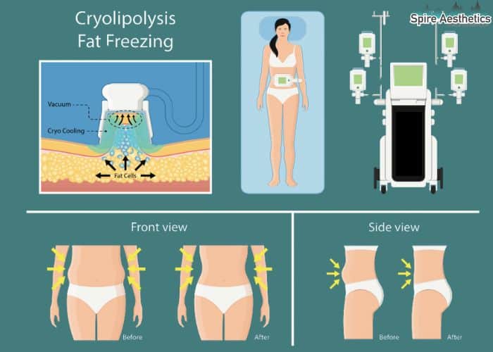 Image of diet and fat freezing combined for best results for Spire Aesthetics Kingswinford