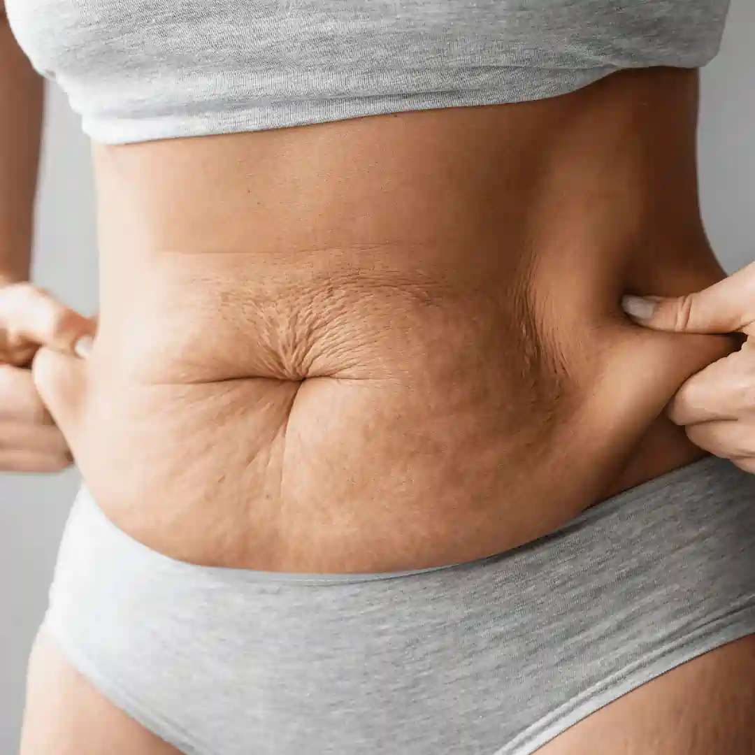 Is It Normal to Have Loose Skin After Pregnancy Kingswinford?