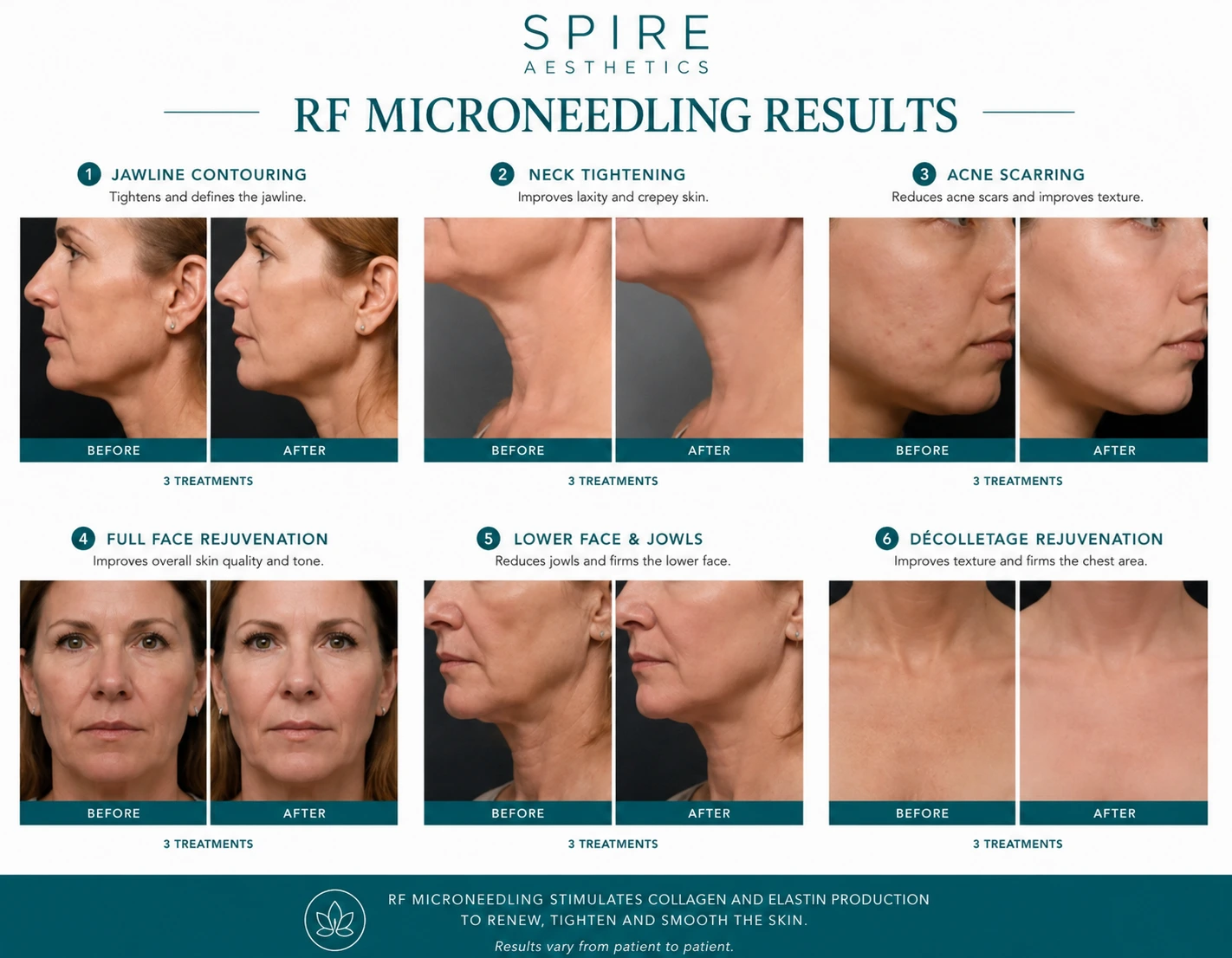 RF Microneedling Skin tightening Kingswinford results