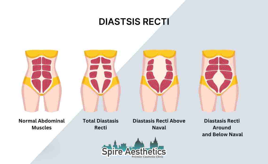 Is Non-Surgical Diastasis Recti Treatment Right for You? Common Concerns Answered Kingswinford